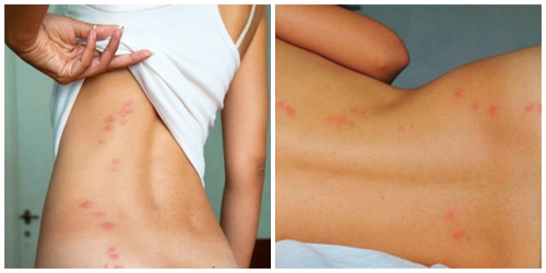 Укусы клопов