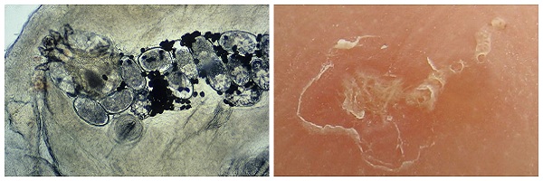 Чесоточный клещ симптомы