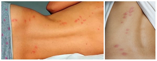 Укусы клопов