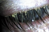 Симптомы и лечение при демодекозе глаз