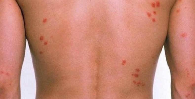 Как выглядят укусы клопов у человека